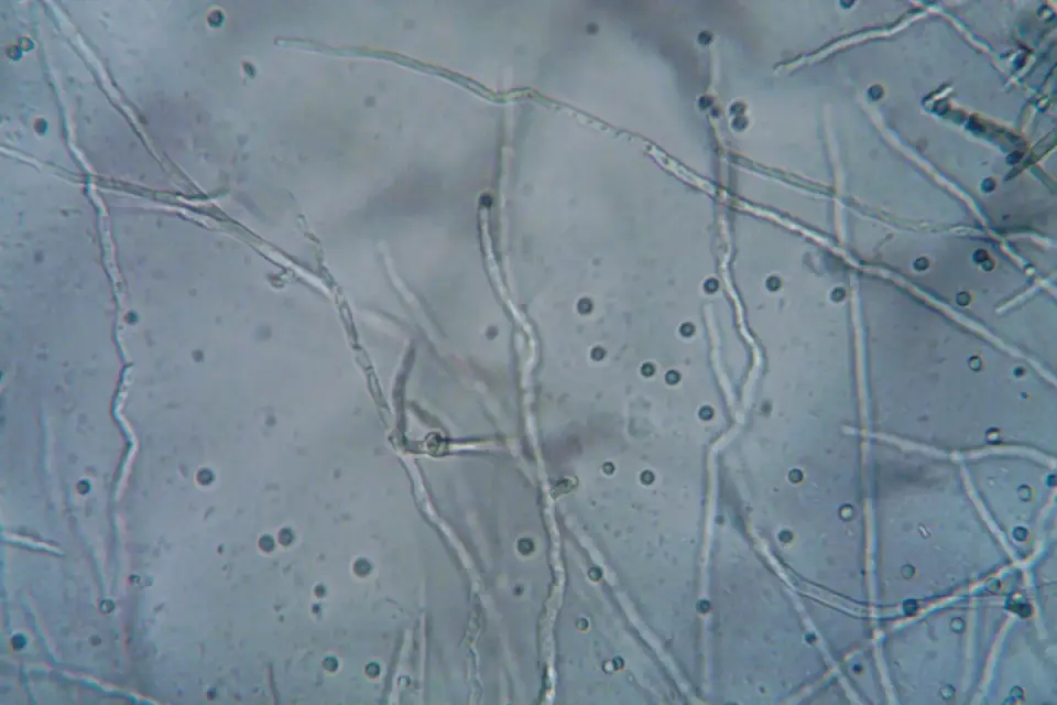 Illustration of damaged red blood cells showing Heinz body formation from onion toxins